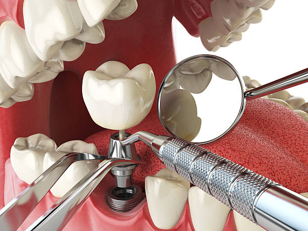 Best Emergency Root Canal Treatment in Yorkville, NY